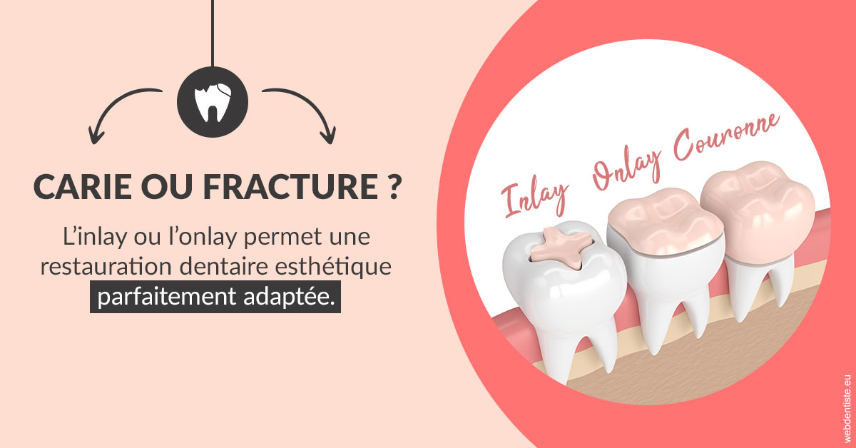 https://selarl-drsboutin.chirurgiens-dentistes.fr/T2 2023 - Carie ou fracture 2
