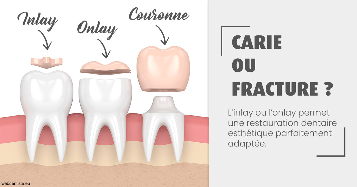 https://selarl-drsboutin.chirurgiens-dentistes.fr/T2 2023 - Carie ou fracture 1