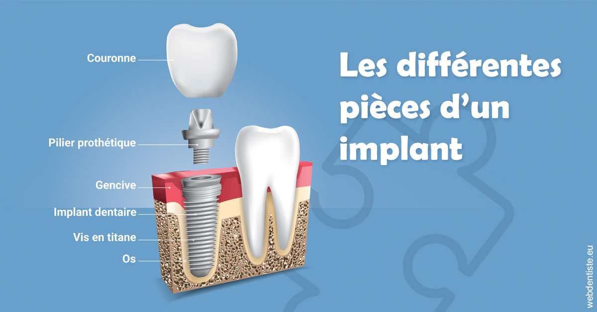 https://selarl-drsboutin.chirurgiens-dentistes.fr/Les différentes pièces d’un implant 1